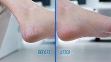 Load image into Gallery viewer, Electric Callus Remover - Built-In Vacuum Rechargeable Motorized Feet Foot Pedicure Tool Exfoliation Dead Skin
